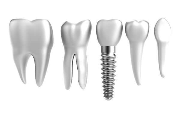 The Nevins Dental Implants